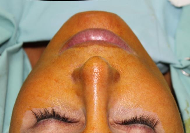 Result after unilateral right-side temporal lift: the right side of the face is elongated; the eyebrow and lateral canthus of the eye are lifted; the cheekbone is positioned higher; SMAS and skin are