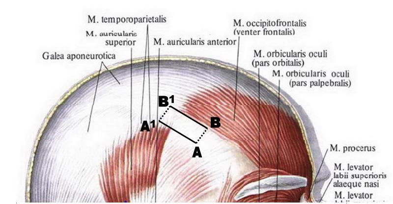Temporal SMAS lift using Serdev sutures 77 SUPPLEMENT SUPRA-TEMPORAL LIFT The Supra-temporal lift presents A-B line fixation of the mobile galea aponeurotica at the hairline to the A1-B1 periosteum