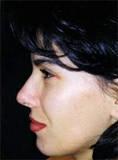 Additional rhinoplasty (author s T-excision technique to lift the tip and columella sliding to project the tip, together with hump