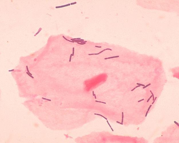 Gram positive Lactobacillus spp. bacilli; the bacteria are the purple rods appearing on top of and around a large vaginal squamous epithelial cell. Photograph courtesy of CDC/Dr.