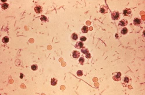 The arrow points out only a very few of the bacteria. Photograph courtesy of CDC Interpretation of Gram stains requires specific training and education.