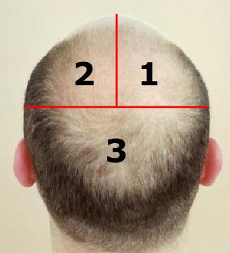 Application of serum should only be in the affected areas and should partially overlap into the existing hairline. 4.