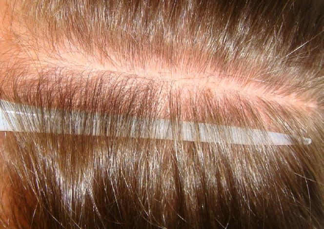 Patient should not color, bleach, or permanent wave hair during the entire course of treatments. Figure 1.