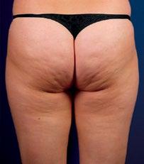 size of the cellulite and help flush away the unwanted bumpy build up that causes that dimpled look. What results can I expect with SleekSKIN?