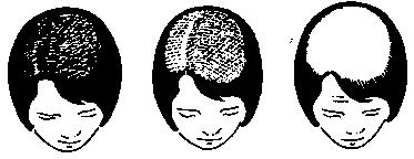 Androgenic or seborrheic alopecia on woman Ludwig classification (on women) Androgenic