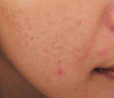 demonstrated by UV light 3 62% 100% acne before condition: Acne, acne scarring and post-inflammatory hyperpigmentation