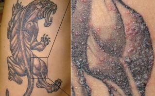 Mycobacterium chelonae red hyperkeratotic papules restricted to grey tattoo areas Potential source of infection: Tap