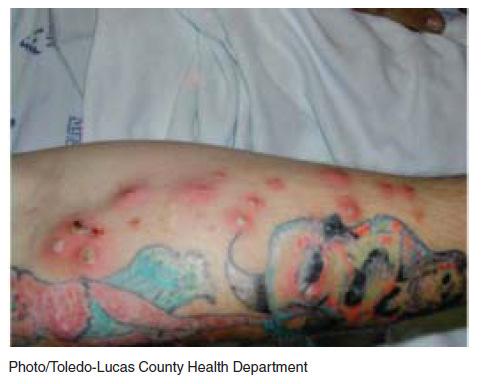 Methicillin-resistant Staphylococcus aureus pustules surrounding in a tattoo recipient Potential source of