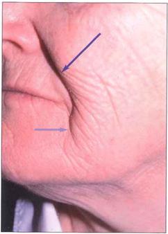 Skin aging skin thickness, breakdown of collagen/elastic Wrinkle Skin laxity melanocyte activity