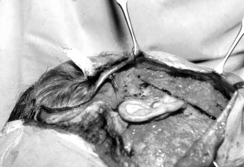 The superior triangular portion of the SMAS was advanced, and the redundant preauricular portion excised.