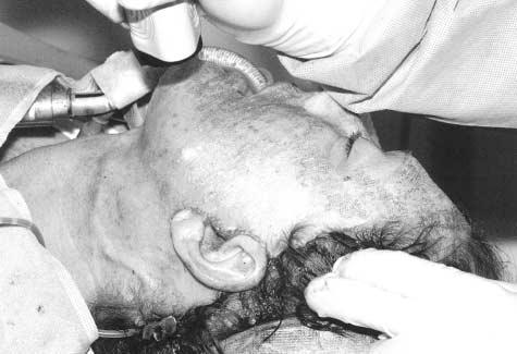 Five patients had simultaneous trichloro acetic acid with Jessner solution chemexfoliation of the neck.