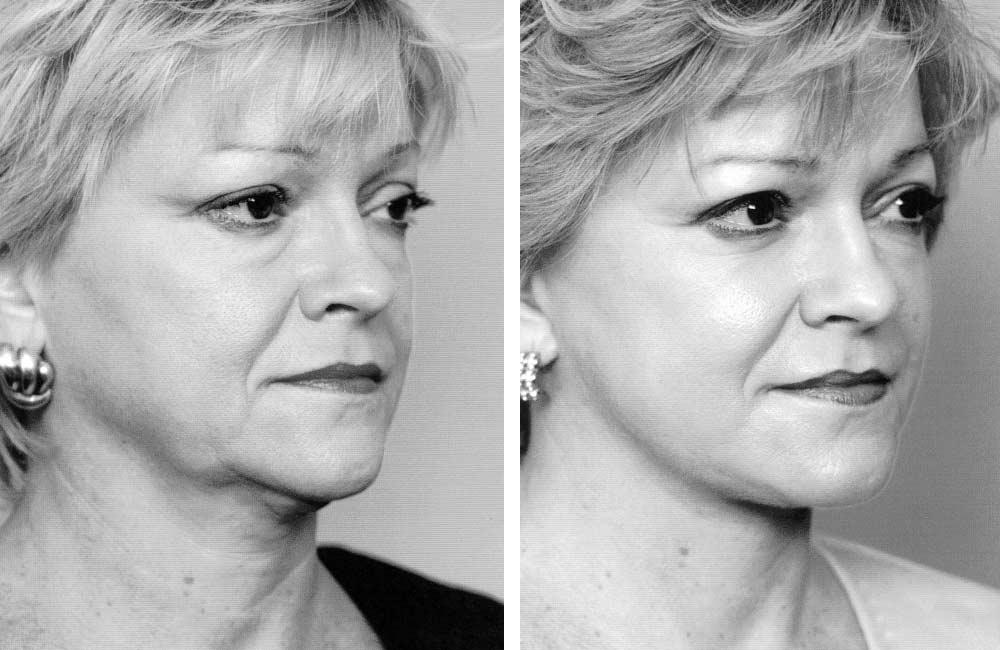 A B Figure 6. A 50-year-old woman preoperatively (A) and 3 months after simultaneous rhytidectomy, full-face laser resurfacing, lower eyelid blepharoplasty, and left cheek scar revision (B).