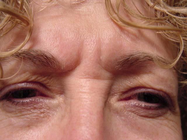 Glabellar Frown Lines Rhytids (wrinkles) between the brows