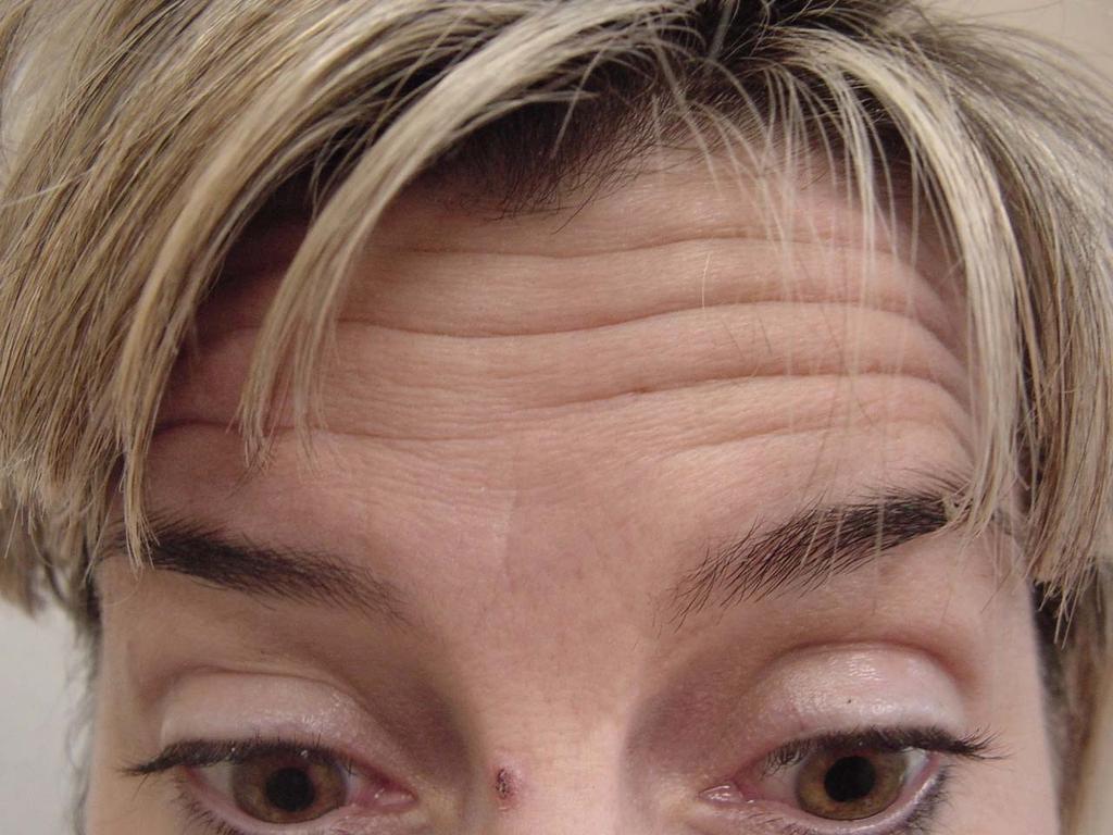 Forehead Lines Rhytids (wrinkles) across