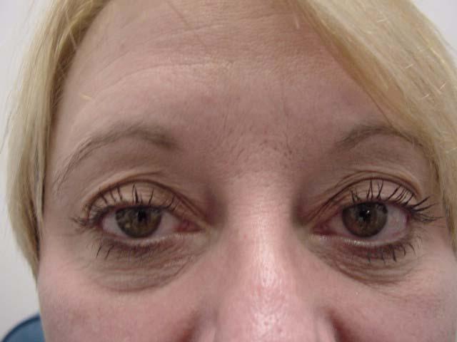 Lateral Brow Lift Performed mainly for female patients Treat