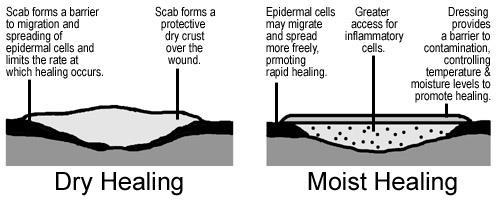 Wound care options Transparent dressings (Tegaderm) uninfected wounds Hydrocolloid (Duoderm) deep and/or uninfected wounds absorbs exudate and acts as barrier Wound care options Hydrogel (Vigilon,