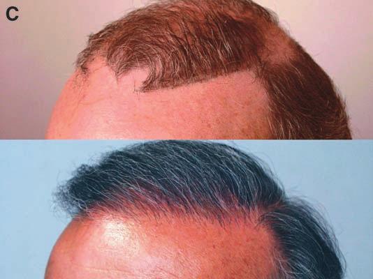 4) was a 56-year-old man who wore a hairpiece to hide the unnatural appearance of his previous transplant