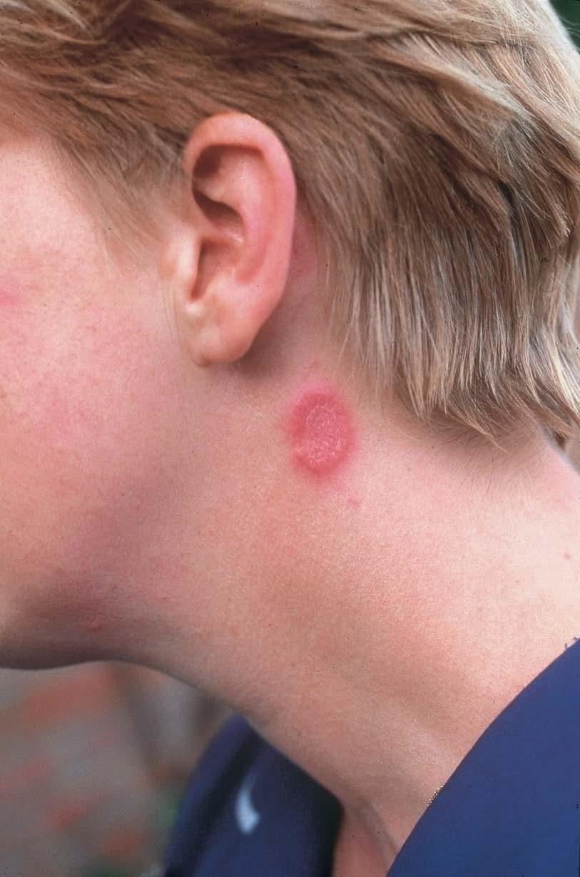 Ringworm Caused by: a fungal infection Refer to GP
