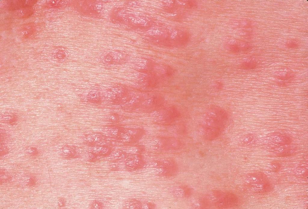 Scabies Caused by: the sarcoptes scabiei mite Refer to GP