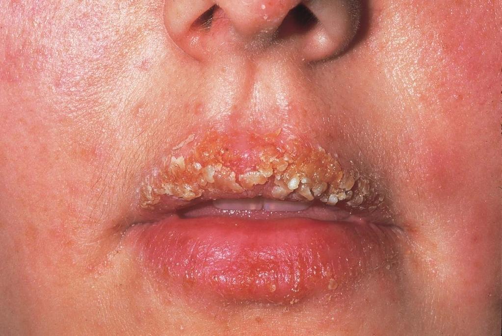 Impetigo Caused by: a bacterial infection Refer to GP