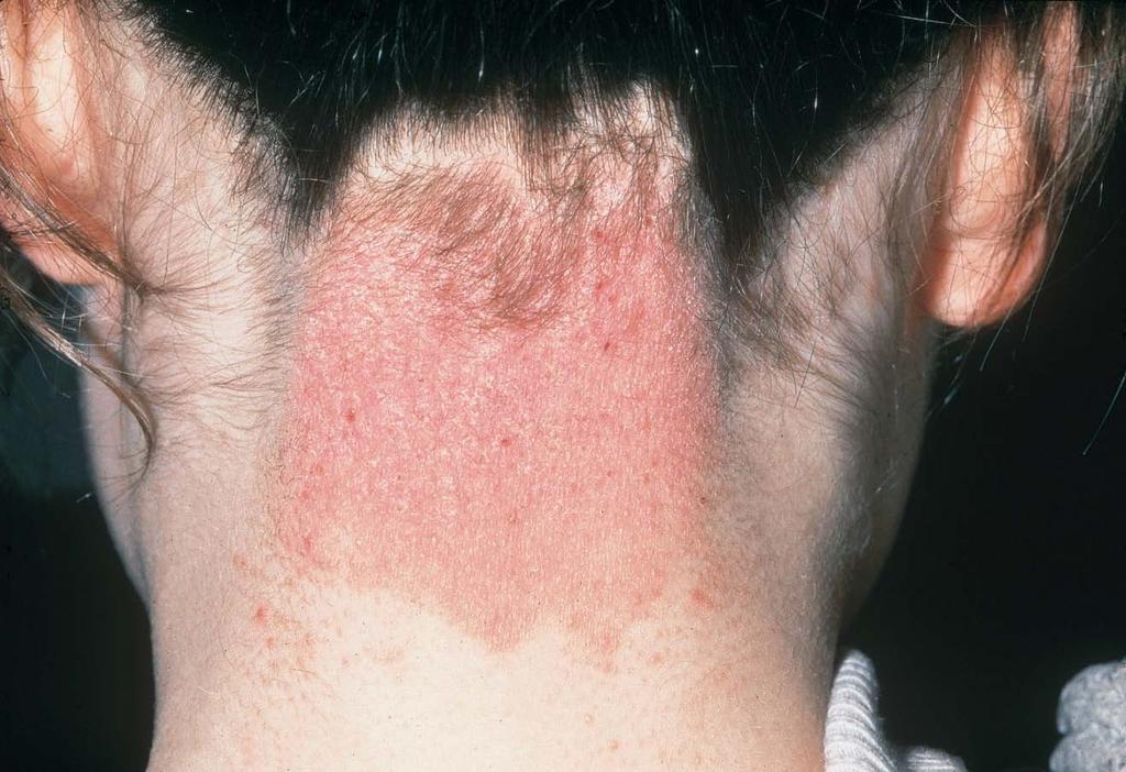 Eczema Caused by: internal or external factors that give rise to an allergic