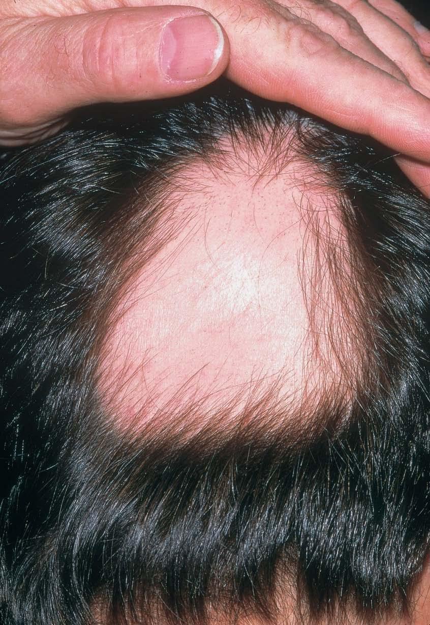 Alopecia areata Caused by: the cause is not fully understood.