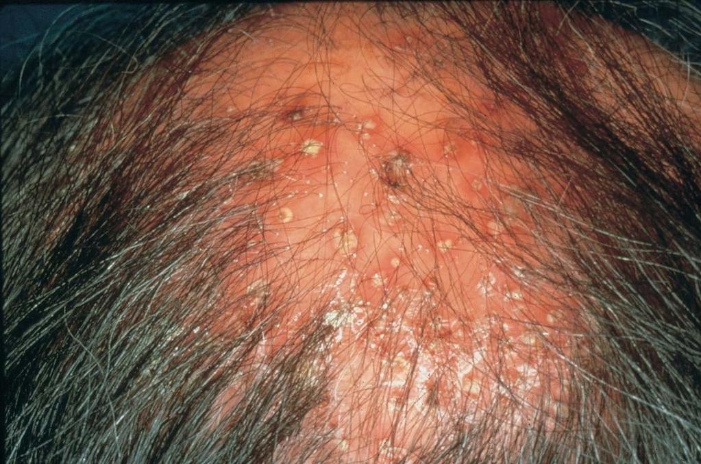 Folliculitis Caused by: a bacterial infection Refer to GP
