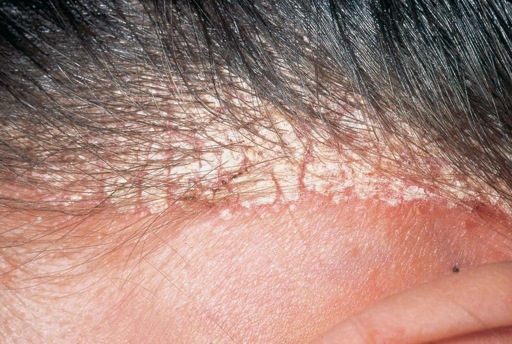 Dandruff Caused by: over production and shedding of epidermal cells Refer to trichologist (if