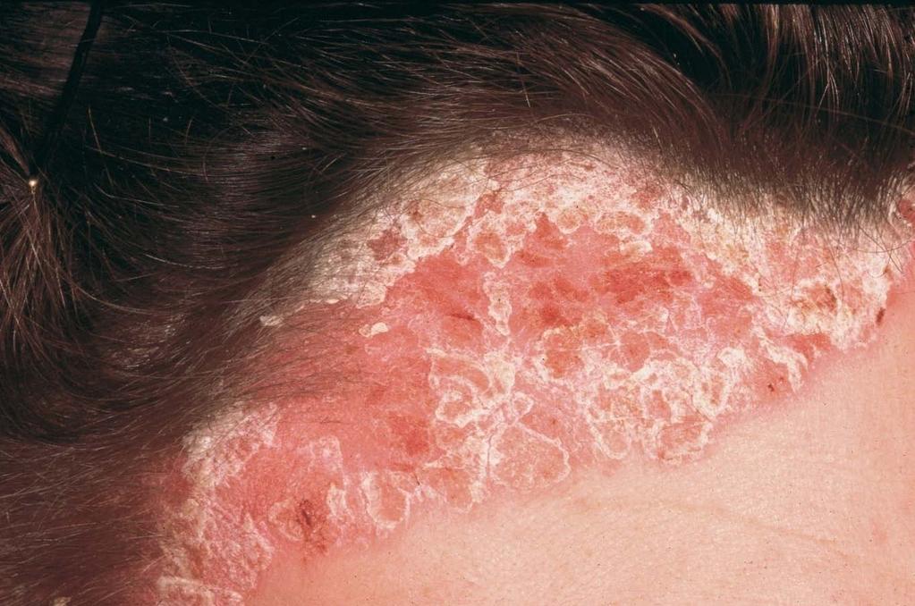 Psoriasis Caused by: either stress or a genetic disorder Refer to GP/