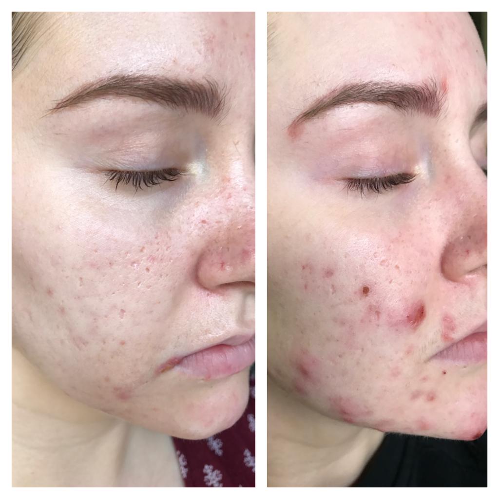 USING COMEDOGENIC INGREDIENTS This is 6 months using comeodgenic ingredients 1-2 times a week only for ONE HOUR before it's removed!
