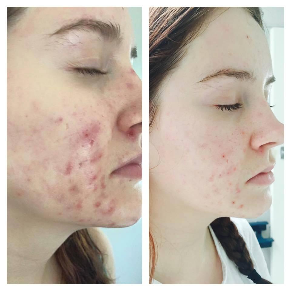 R O C C O C O C A S E S T U D I E S The client is 22 and suffers from PCOS. Her skin was not improving with her Roccoco routine at the time.