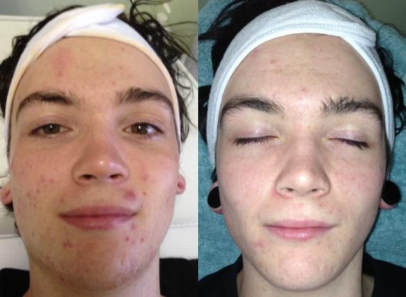 The client is 20 and has suffered from inflammatory and cystic acne from his early teenage years. He tried many products but failed to get his acne under control.