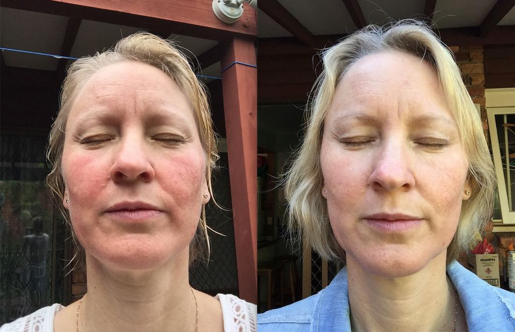 The client is 42 and suffers from Rosacea. She tried antibiotics and other skincare products but saw no improvement.