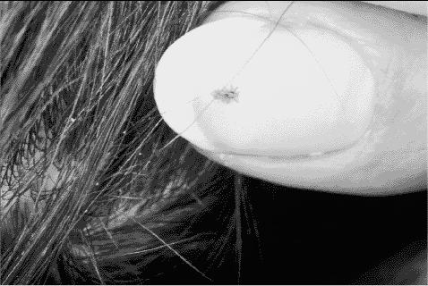 Treating & controlling Head Lice A. Licid B.
