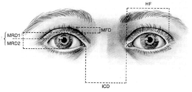 Blepharoptosis (Upper eyelid ptosis) margin fold distance (MFD) margin reflex distance 1 (MRD-1) 4-4.