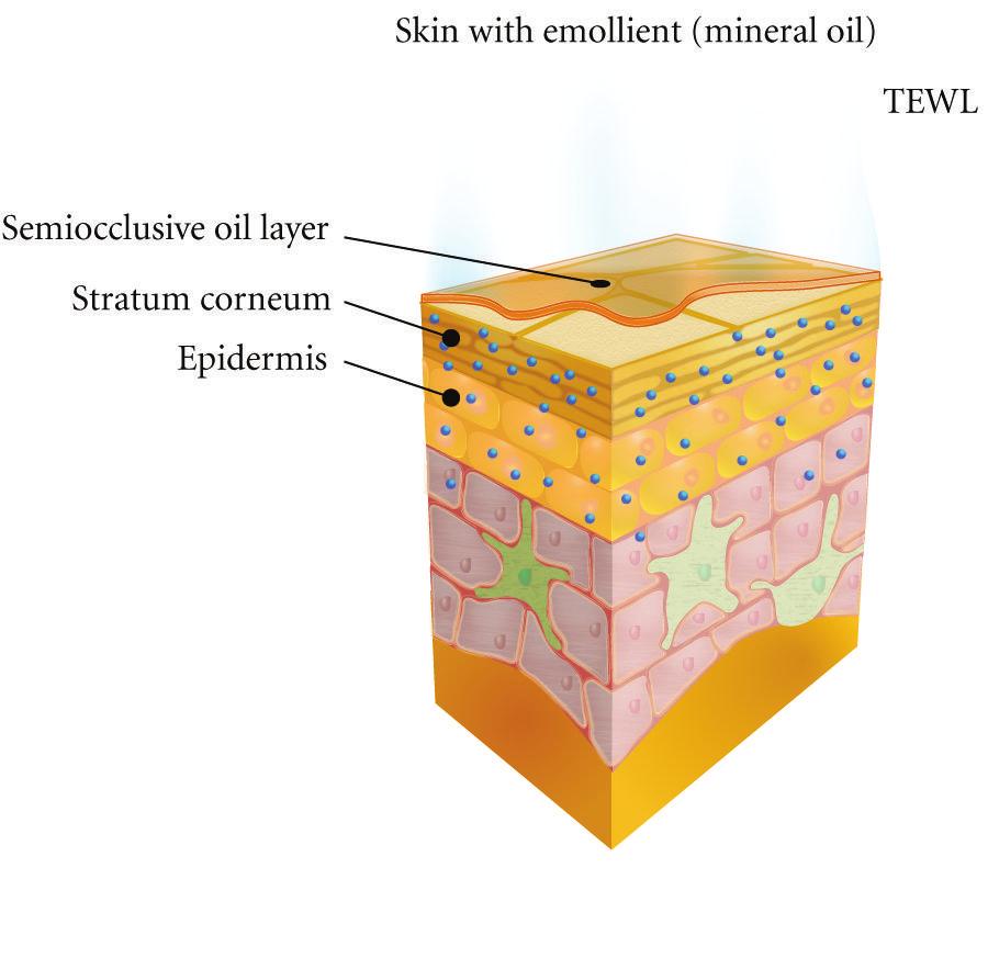 Oils in the emollient create a semiocclusive layer. The reduction in water evaporation leads to greater water retention in the SC.