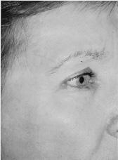 Some tightening of the eyelid skin also occurs with this procedure.