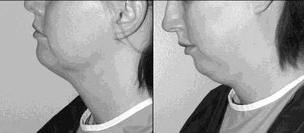 Figure 1. This 28-year-old woman has longstanding neck fullness and no prior history of surgery. just above the hyoid.