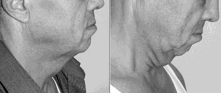 Figure 2. This 65-year-old man has had no prior surgery. some other improvements that I could bring to her face at the same time. Dr. Marten: Dr.