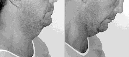 Figure 3. This 45-year-old man had submental liposuction and a weekend neck lift. ed the subplatysmal surgery, I would perform a corset platysmaplasty and neck skin redistribution. Dr. Marten: Dr.