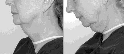 Figure 4. This 61-year-old woman with long-standing neck fullness has no prior history of surgery. number of years I did use them as an adjunct to the corset platysmaplasty.