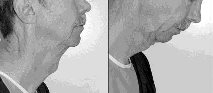 Figure 5. This 58-year-old man has had no prior surgery. tic implant, extending from the anterior mandibular area around the chin to the other side.