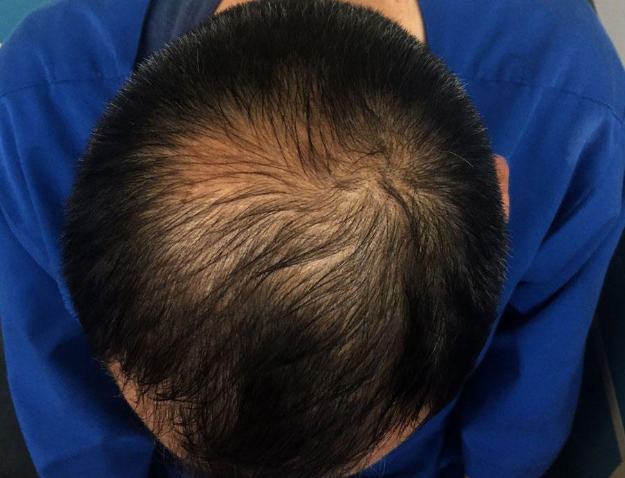Not knowing how or why it s happening can also be frustrating. Hair loss can be caused by a number of factors.