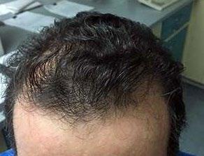 from hair loss or thinning issues.