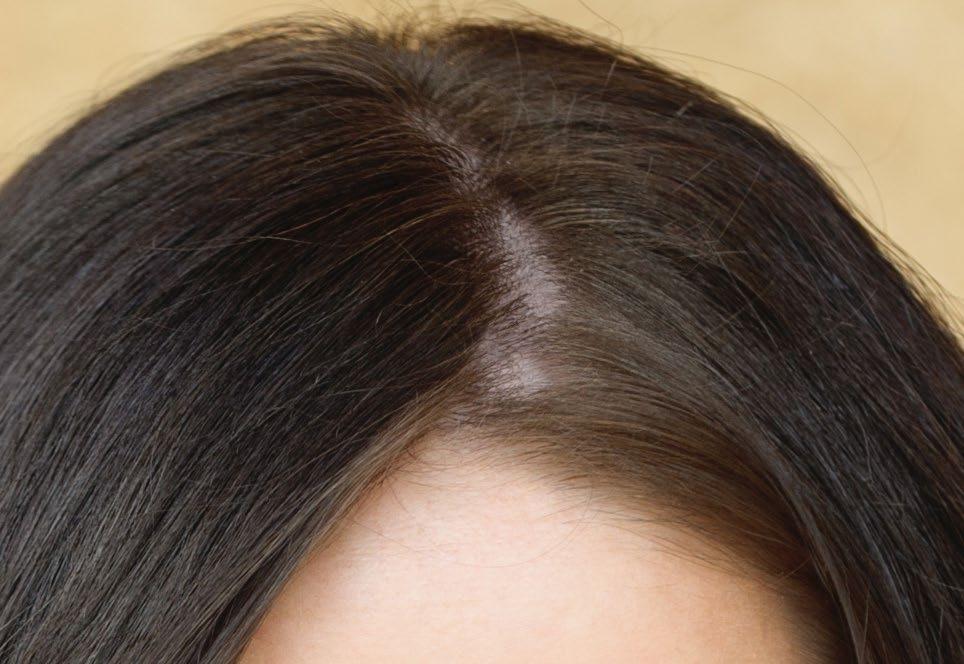 Women And Men Are Affected By Hair Loss In Different Ways Women make up 40% of American hair loss sufferers.