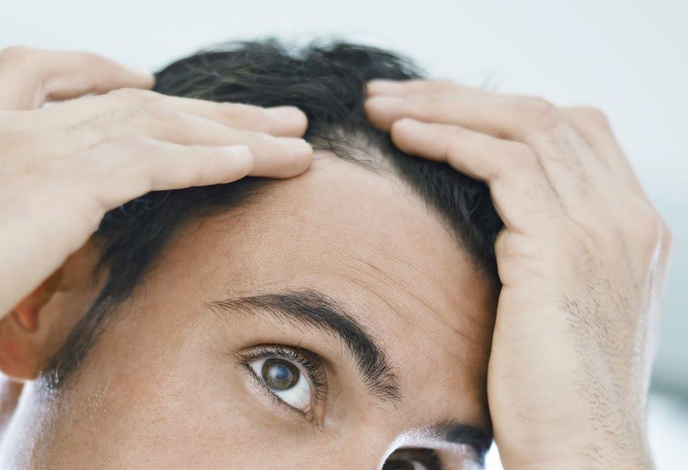 By age 35, two-thirds of American Men will experience some degree of hair loss. By age 50 approximately 85% of men have significantly thinning hair.