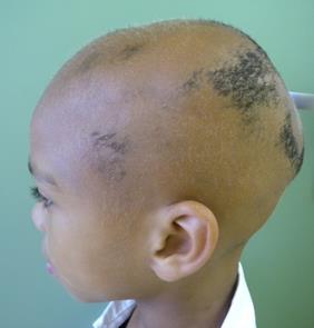 In auto-immune alopecia