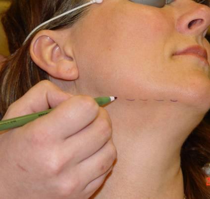 Patient Prep Marking If you want to avoid treatment of the neck, the skin may be marked along the mandible using a surgical marker.