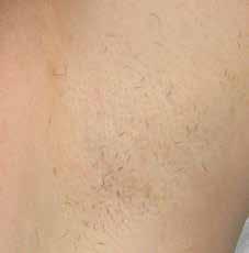 Offer Your Patients a Fast & Effective Hair Removal Treatment Hair removal is one of the most popular aesthetic treatments today, and using the