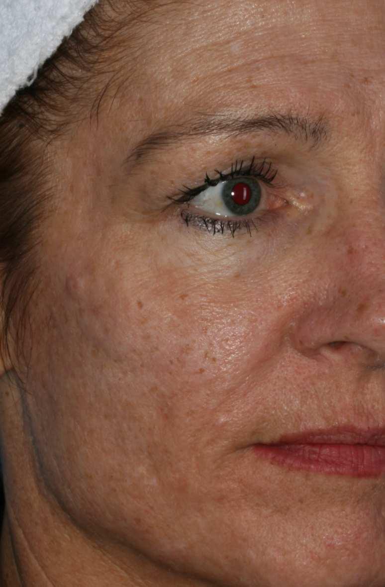 A Fig8. Marked improvement skin tone & texture 1 month after treatment of.